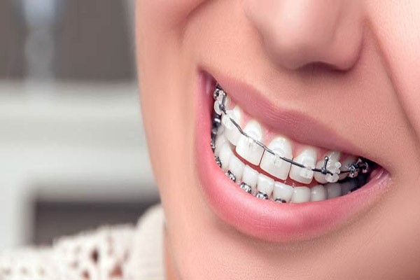 بهترین و محبوب ترین انواع ارتودنسی دندان در 1400