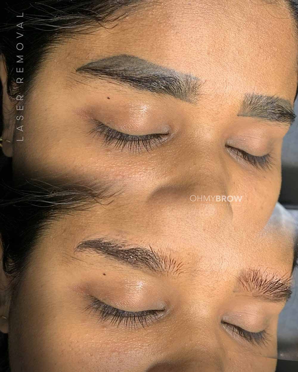 10 Laser Eyebrow Tattoo Removal Before and After Cases & What They Had in  Common — OHMYBROW