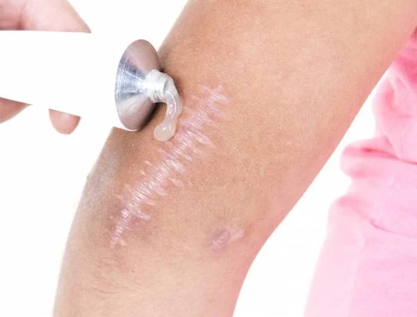 با این روش های خانگی از شر جای زخم و بخیه خلاص شوید
